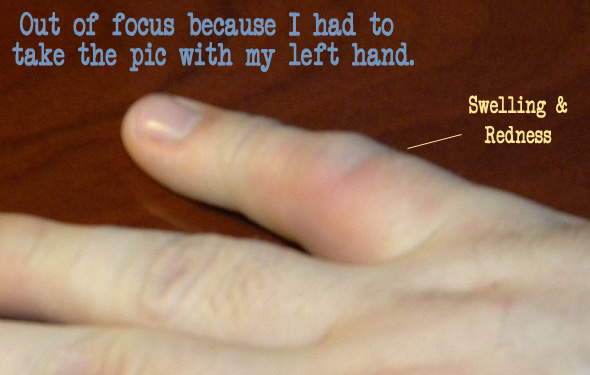Dislocated finger Dislocated finger