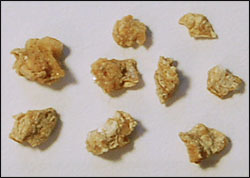kidney stones